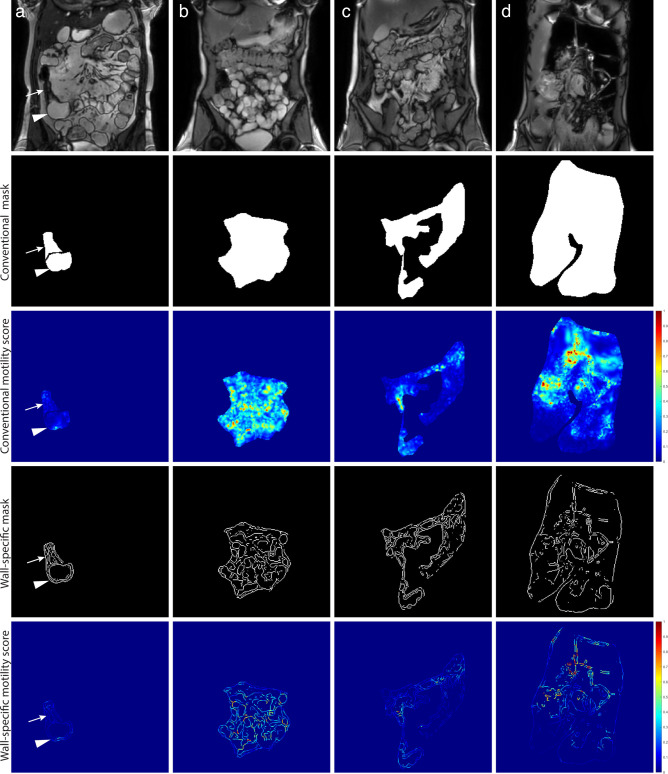 Impact of bowel dilation on small bowel motility measurements with cine-MRI: assessment of two quantification techniques.