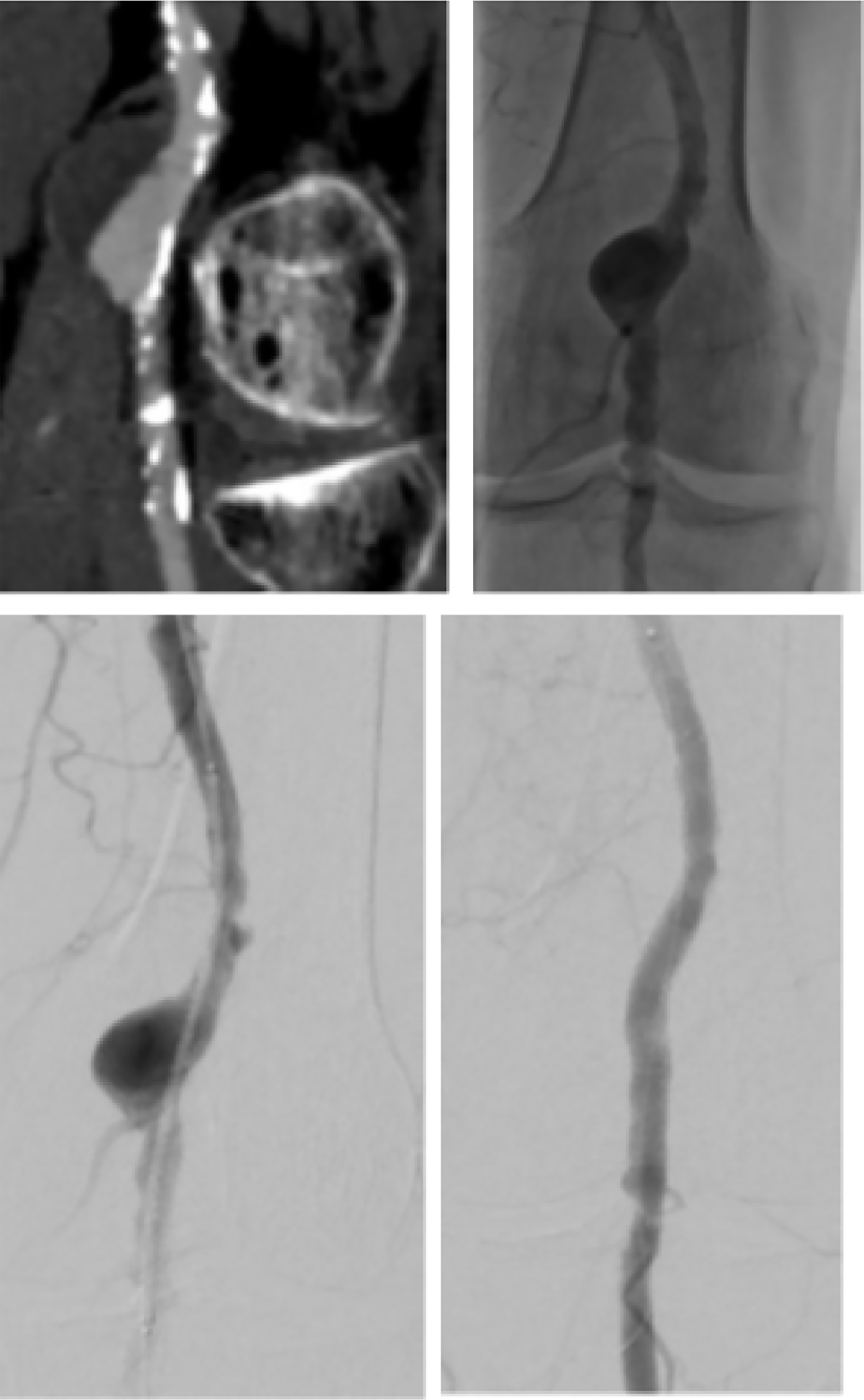 Early Results after Exclusion of Popliteal Aneurysms with an Endoprosthesis.