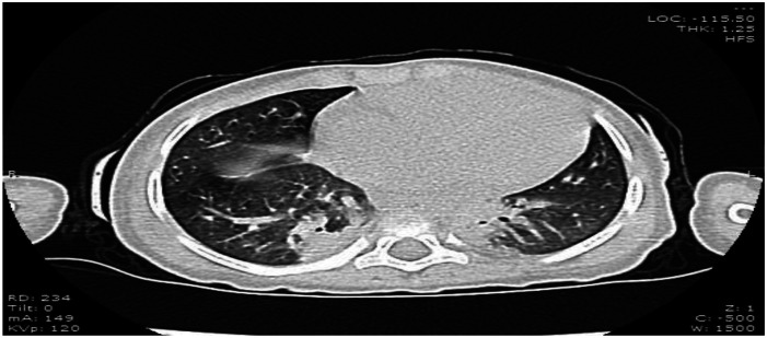 COVID-19 diversity: A case of multisystem inflammatory syndrome in children masquerading as juvenile systemic lupus erythematosus.