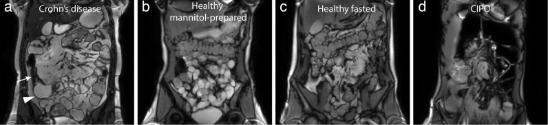 Impact of bowel dilation on small bowel motility measurements with cine-MRI: assessment of two quantification techniques.