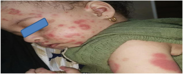 COVID-19 diversity: A case of multisystem inflammatory syndrome in children masquerading as juvenile systemic lupus erythematosus.