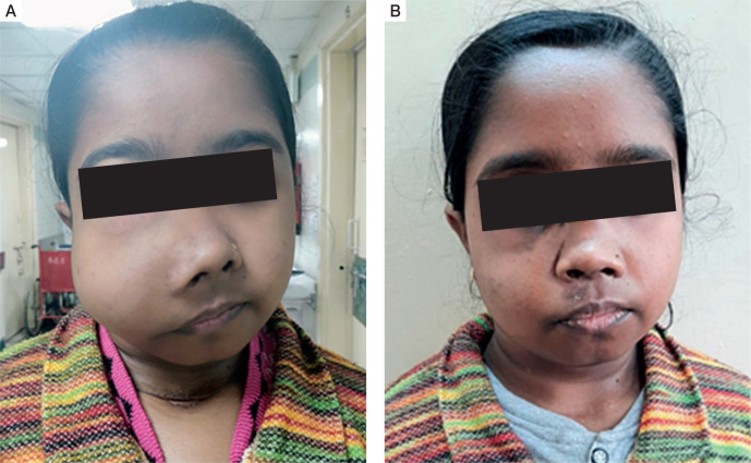 The spectrum of manifestations of primary hyperparathyroidism in children and adolescents.