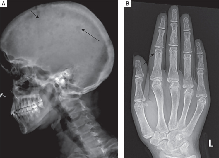 The spectrum of manifestations of primary hyperparathyroidism in children and adolescents.