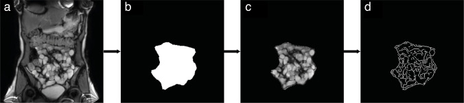 Impact of bowel dilation on small bowel motility measurements with cine-MRI: assessment of two quantification techniques.