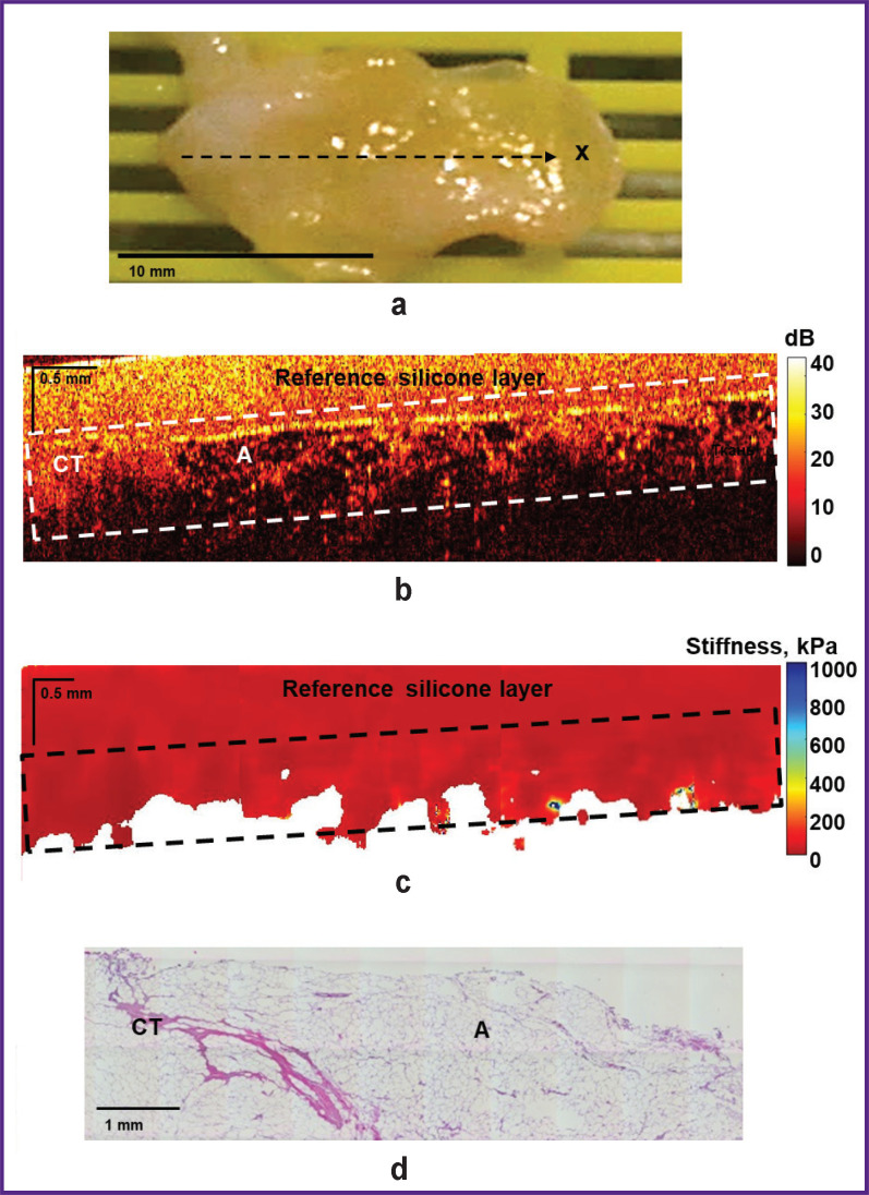 Multimodal Optical Coherence Tomography for Intraoperative Evaluation of Tumor Margins and Surgical Margins in Breast-Conserving Surgery.