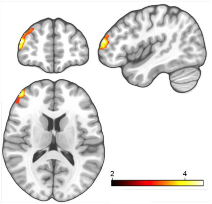 Increased left dorsolateral prefrontal cortex density following escitalopram intake during relearning: a randomized, placebo-controlled trial in healthy humans.