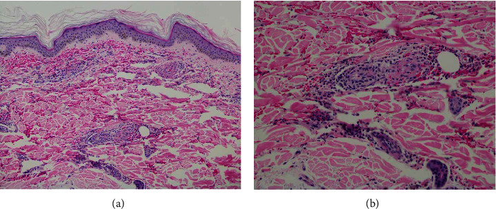 A Rare Cutaneous Manifestation: Leukocytoclastic Vasculitis after Pfizer-BioNTech COVID-19 Vaccination.