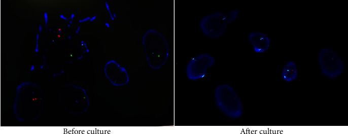 Assessment of Combined Karyotype Analysis and Chromosome Microarray Analysis in Prenatal Diagnosis: A Cohort Study of 3710 Pregnancies.