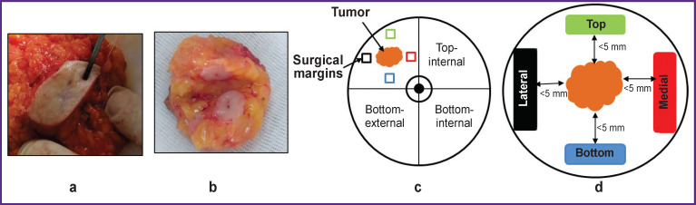 Multimodal Optical Coherence Tomography for Intraoperative Evaluation of Tumor Margins and Surgical Margins in Breast-Conserving Surgery.