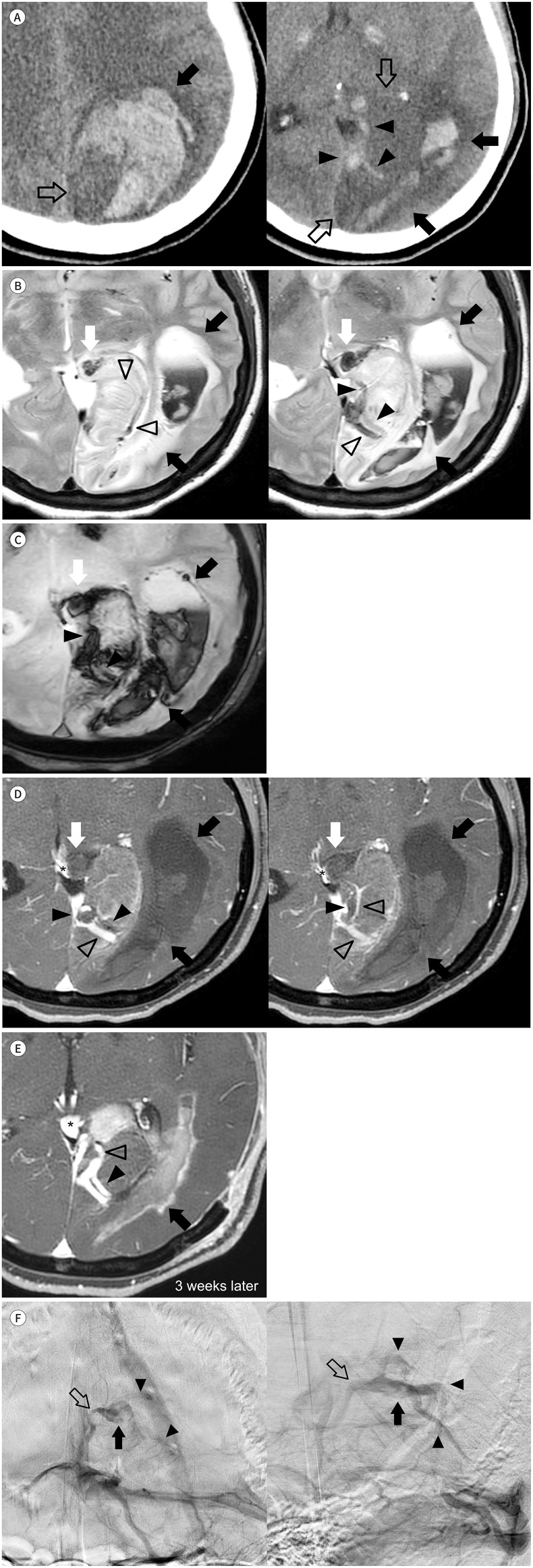 Intracerebral Hemorrhage Caused by Thrombosis of a Developmental Venous Anomaly with an Unusual Structure: A Case Report.