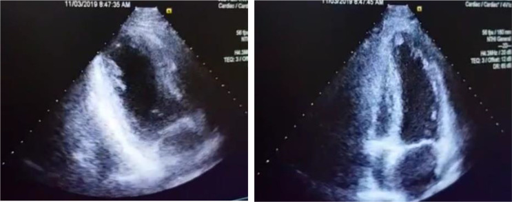 Marijuana-induced myocarditis in a 24-year-old man.