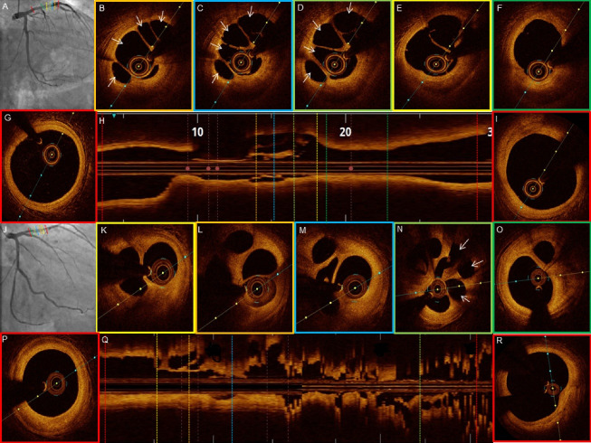 Optical coherence tomography characterization of spontaneous recanalized coronary thrombus - Single center experience.