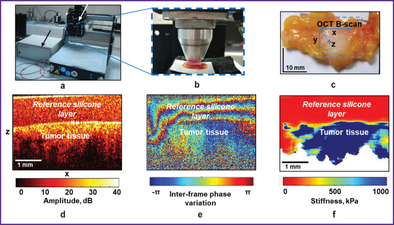 Multimodal Optical Coherence Tomography for Intraoperative Evaluation of Tumor Margins and Surgical Margins in Breast-Conserving Surgery.