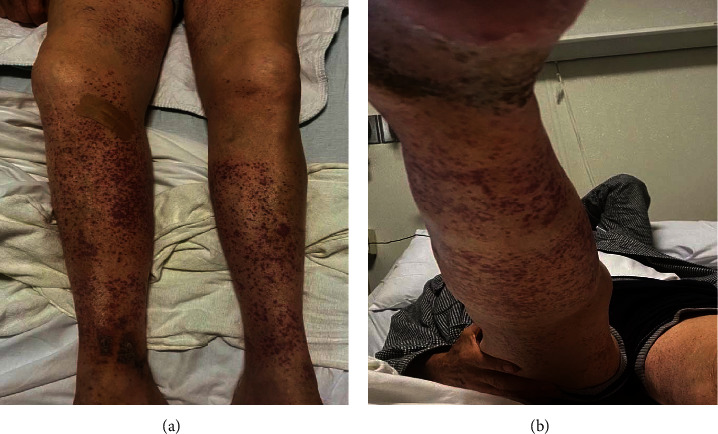 A Rare Cutaneous Manifestation: Leukocytoclastic Vasculitis after Pfizer-BioNTech COVID-19 Vaccination.