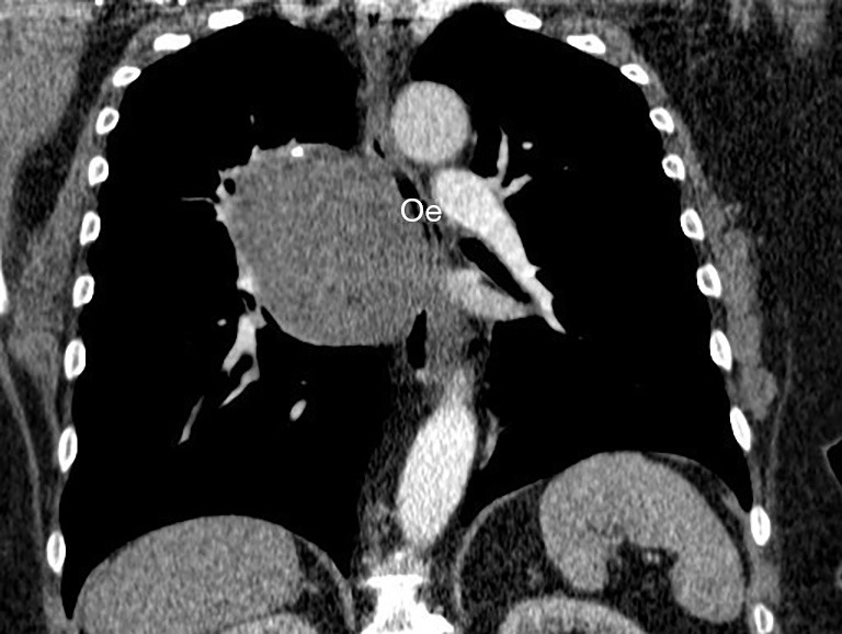 A case report of a giant middle mediastinal leiomyosarcoma.