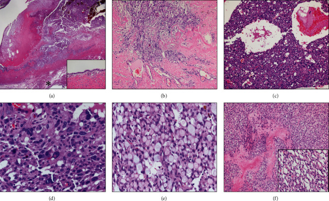 Microcystic Stromal Tumor with Predominant Bizarre Nuclei of Ovary in a Pregnant Woman.