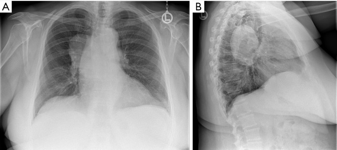 A case report of a giant middle mediastinal leiomyosarcoma.