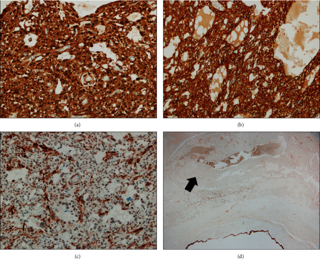 Microcystic Stromal Tumor with Predominant Bizarre Nuclei of Ovary in a Pregnant Woman.