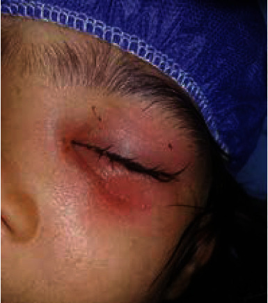 Button Battery-Induced Necrotizing Keratoconjunctivitis: Case Report.