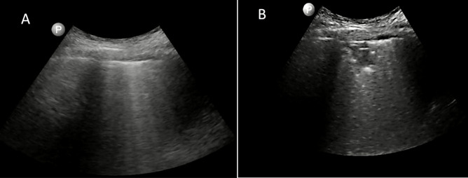 Role of Point of Care Ultrasonography in Patients with COVID-19 Associated Acute Kidney Injury.