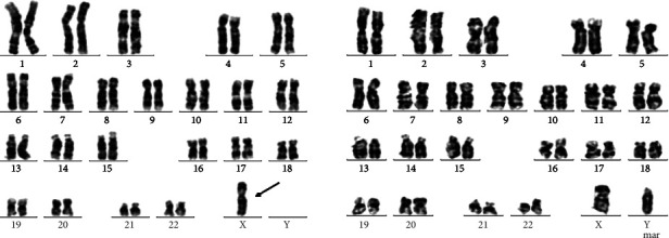 Assessment of Combined Karyotype Analysis and Chromosome Microarray Analysis in Prenatal Diagnosis: A Cohort Study of 3710 Pregnancies.