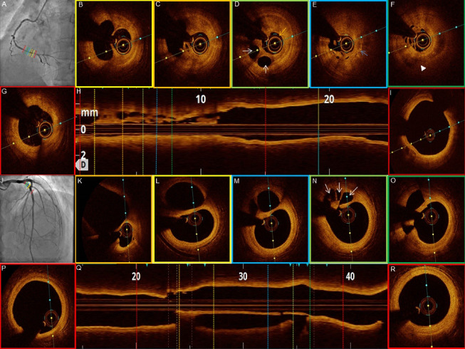 Optical coherence tomography characterization of spontaneous recanalized coronary thrombus - Single center experience.