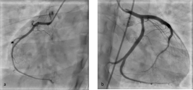 Marijuana-induced myocarditis in a 24-year-old man.