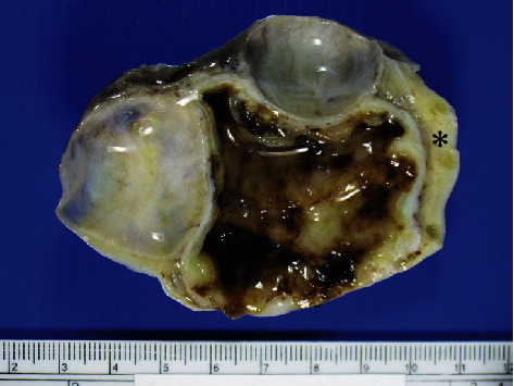 Microcystic Stromal Tumor with Predominant Bizarre Nuclei of Ovary in a Pregnant Woman.