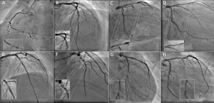 Optical coherence tomography characterization of spontaneous recanalized coronary thrombus - Single center experience.