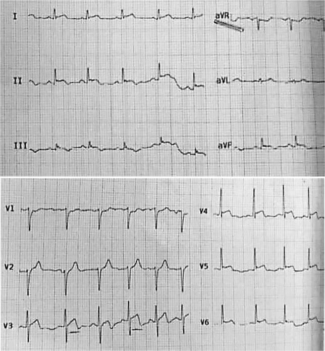 Marijuana-induced myocarditis in a 24-year-old man.