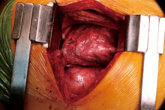 A case report of a giant middle mediastinal leiomyosarcoma.