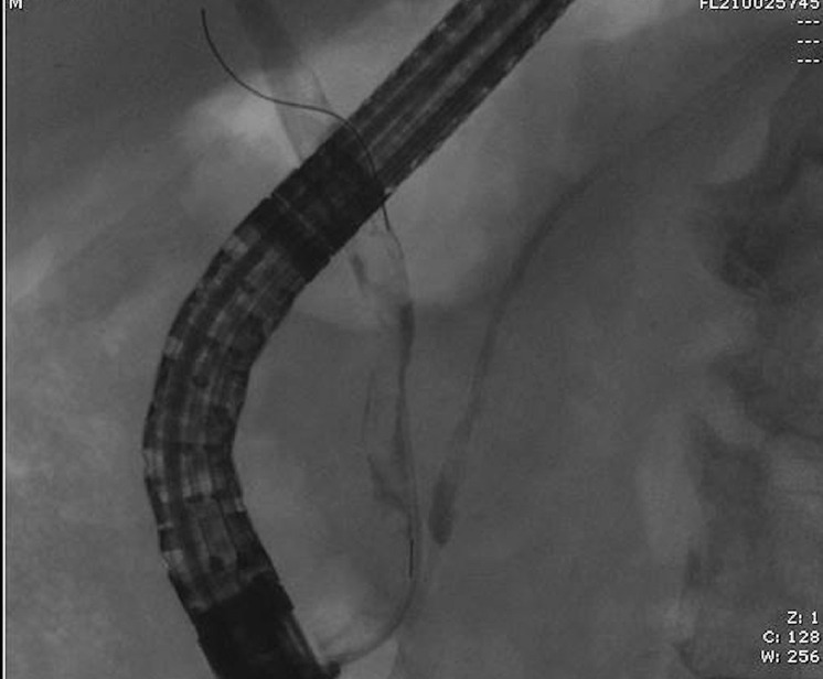 Critical Illness Cholangiopathy in COVID-19 Long-haulers