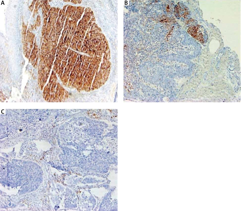 Correlation of PD-L1 expression with toxicities and response in oropharyngeal cancers treated with definitive chemoradiotherapy.