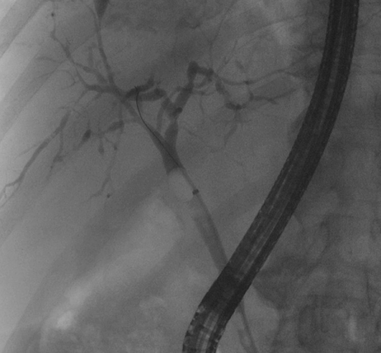 Critical Illness Cholangiopathy in COVID-19 Long-haulers