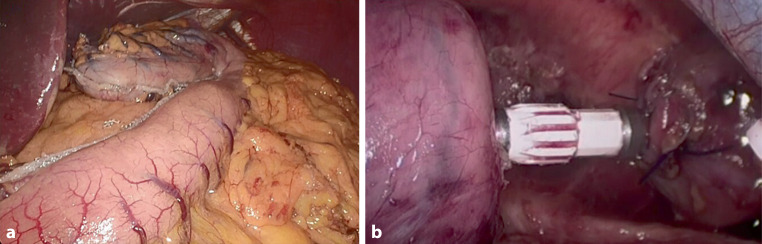 Minimally invasive esophagectomy for cancer in COVID hospitals and oncological hubs: are the outcomes different?