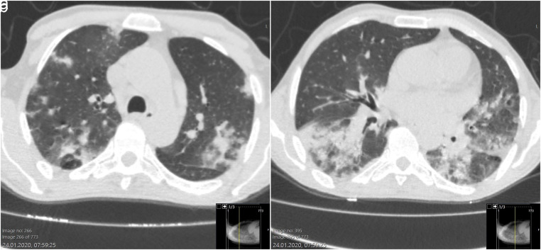 Case of Prolonged Viral Shedding: Chronic, Intermittan COVID-19?