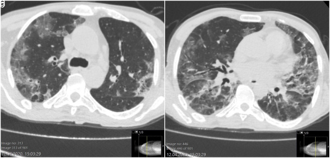 Case of Prolonged Viral Shedding: Chronic, Intermittan COVID-19?