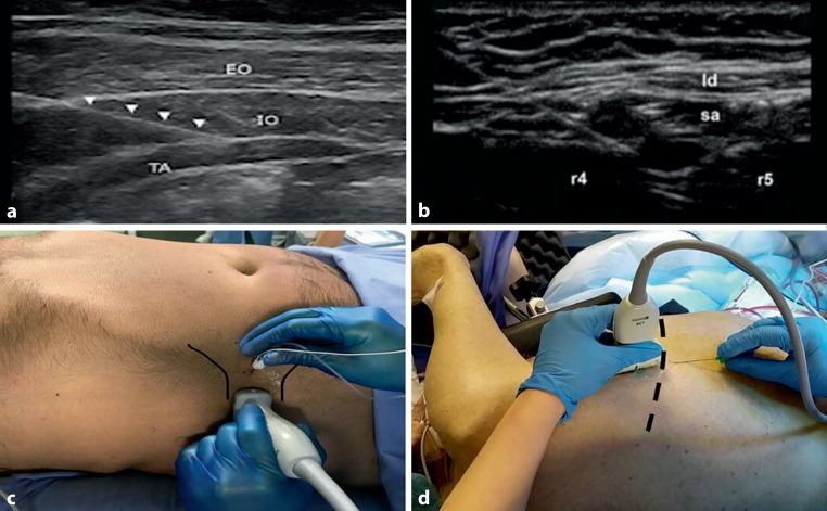 Minimally invasive esophagectomy for cancer in COVID hospitals and oncological hubs: are the outcomes different?