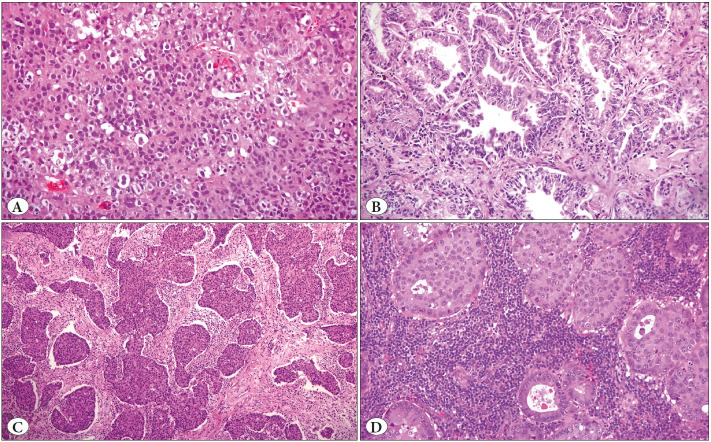 Programmed Cell Death Ligand 1 Expression in Cytological and Surgical Non-Small Cell Lung Cancer Specimens in Association with EGFR Mutation and Overall Survival: A Single-Institution Experience.