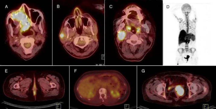 Non-Cutaneous Melanoma, Findings and Prognostic Value of FDG PET/CT: A Case Series of 23 patients and review of the literature.