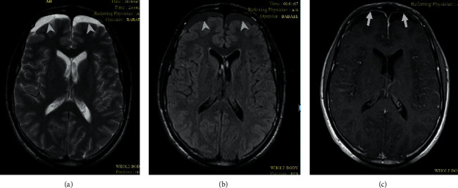 Steroid-Responsive Post-Traumatic Persistent Neutrophilic Meningitis.