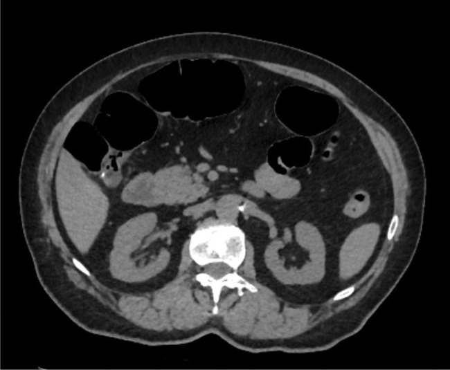 Post-polypectomy coagulation syndrome: a tricky to diagnose hot snare problem that can be eliminated thanks to cold snare revolution.