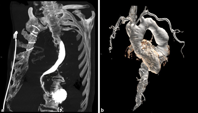 Dysphagia aortica.