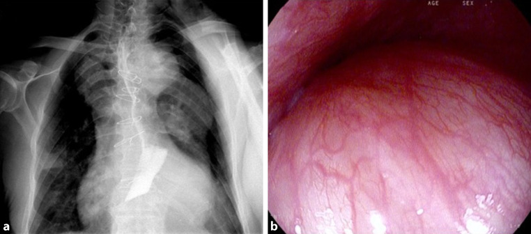 Dysphagia aortica.