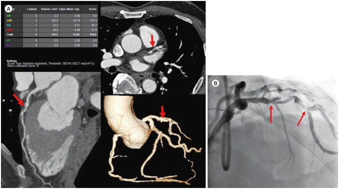[Use of Coronary CT Angiography as a Screening Tool for Coronary Artery Disease in Asymptomatic Healthy Individuals or Patients].