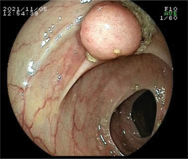 Post-polypectomy coagulation syndrome: a tricky to diagnose hot snare problem that can be eliminated thanks to cold snare revolution.