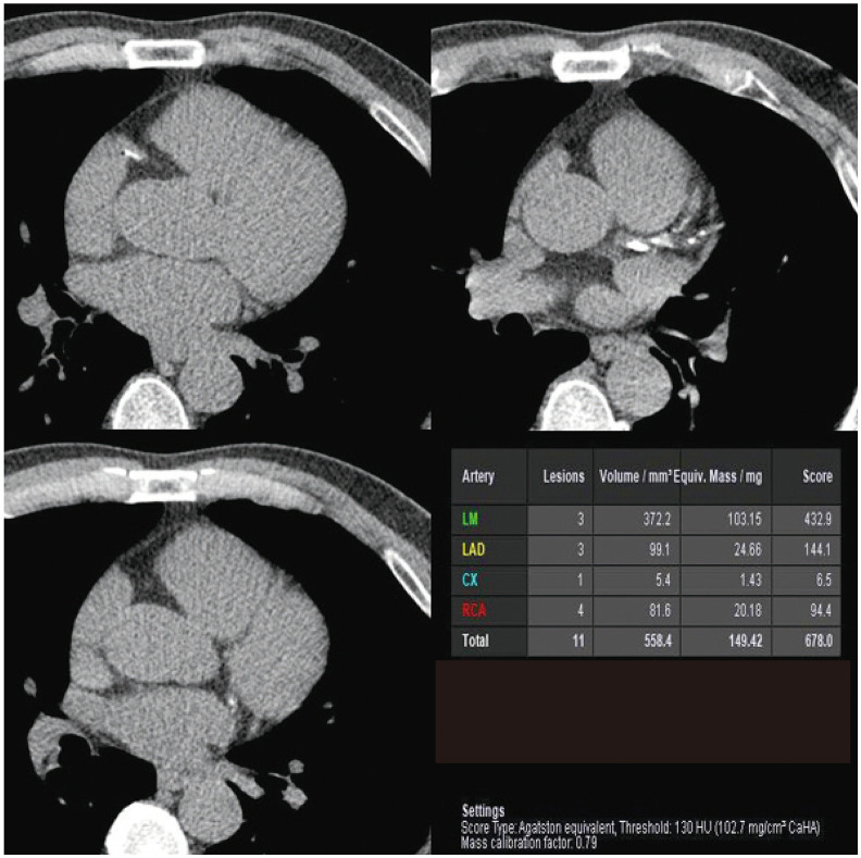 [Use of Coronary CT Angiography as a Screening Tool for Coronary Artery Disease in Asymptomatic Healthy Individuals or Patients].