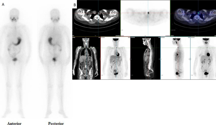 Impact of <sup>18</sup>F-FDG PET/CT on treatment of patients with differentiated thyroid carcinoma, negative <sup>131</sup>I whole body scan and elevated serum thyroglobulin.