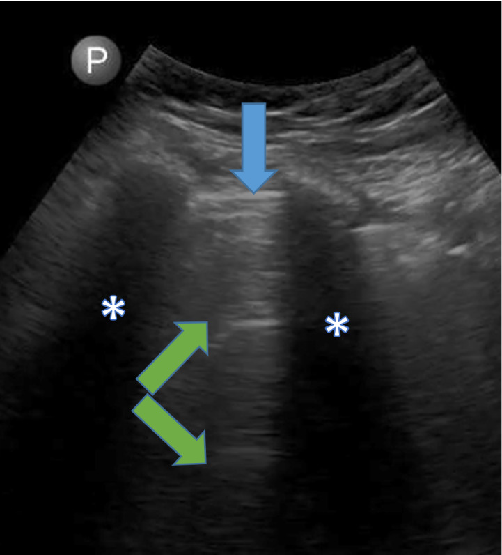 Recovery of Severe Acute Kidney Injury in a Patient with COVID-19: Role of Lung Ultrasonography.