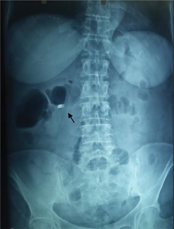 Post-polypectomy coagulation syndrome: a tricky to diagnose hot snare problem that can be eliminated thanks to cold snare revolution.